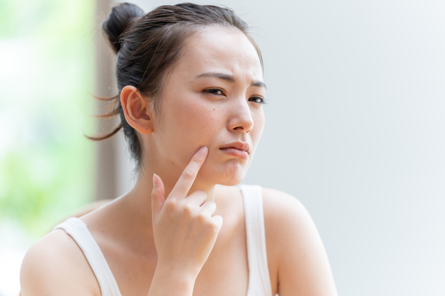 ｢ニキビができやすい人｣の体質を医師が解説 大人ニキビ･吹き出物予防のための体質改善法･スキンケアとは?